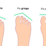 ¿Qué tipo de pie es el más común?